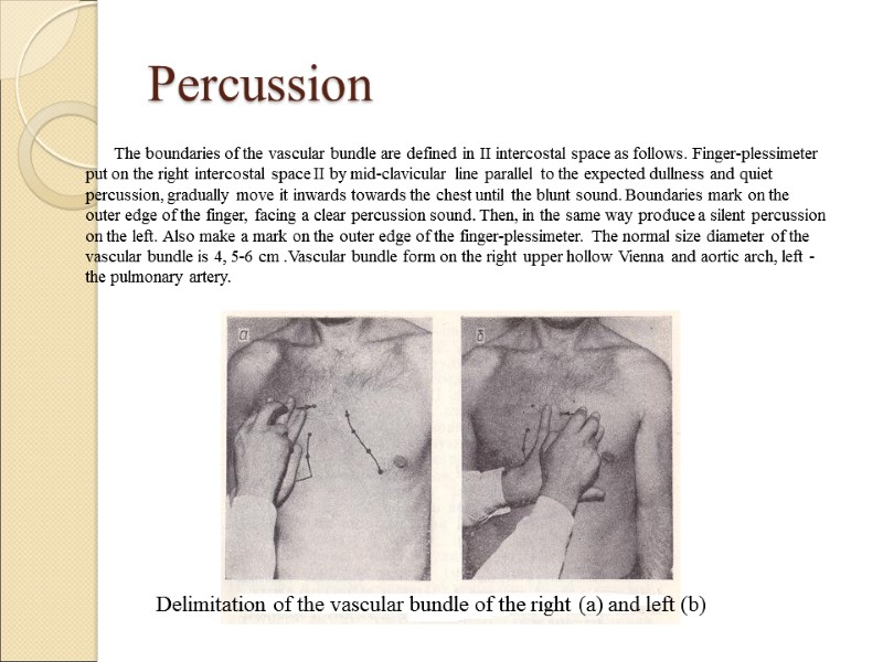 Percussion The boundaries of the vascular bundle are defined in II intercostal space as